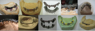 dentwise implant suprastructures